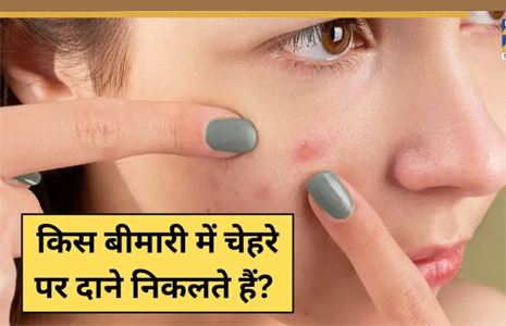 किस बीमारी में चेहरे पर निकलते हैं दाने? बार-बार फुंसियां निकलें तो ना करें इग्नोर
