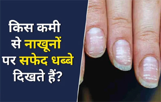 नाखूनों पर सफेद धब्बे किस कमी की वजह से होते हैं? यहां जानिए कैसे दूर होगी दिक्कत
